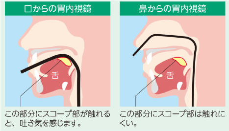 胃カメラ検査は、鼻から”または“口から”。